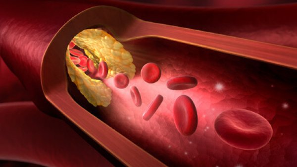 Schematische Darstellung eines Blutgefäßes, welches durch Ablagerungen an der inneren Wandschicht verengt wird.