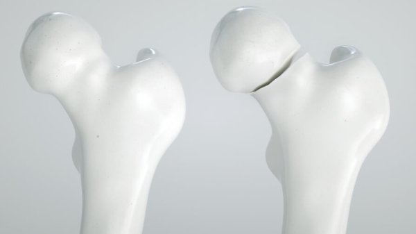 Darstellung zweier Oberschenkel-Modelle. Ein Modell zeigt einen gesunden Oberschenkelknochen. Das andere Modell zeigt einen Bruch des Oberhalsknochens.