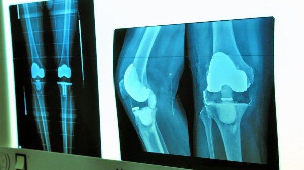 Röntgenbild eines künstlichen Kniegelenks.