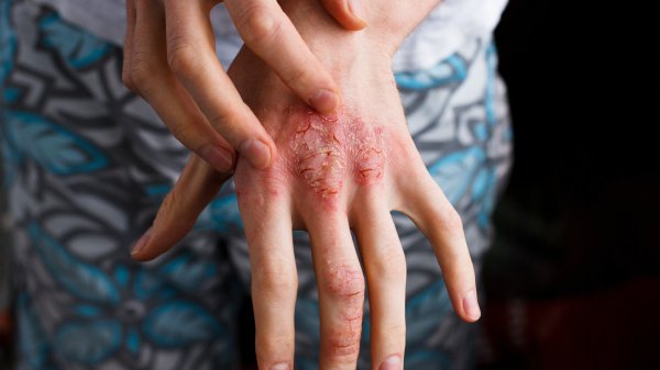 Person kratzt sich an einer Hand, welche betroffen von einer rheumatischen Schuppenflechte ist.