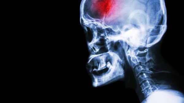 Seitliche Röntgenaufnahme eines menschlichen Kopfes. Der Stirnbereich ist farblich hervorgehoben, mit erkennbaren Schlaganfall.