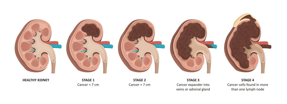 Grafische Darstellung der Nieren mit verschiedenen Tumorstadien