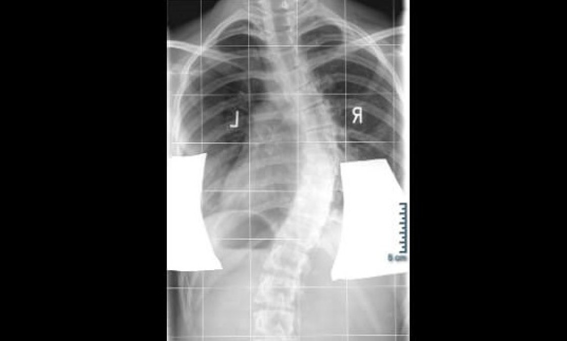 Röntgenbild einer Skoliose an der Wirbelsäule.