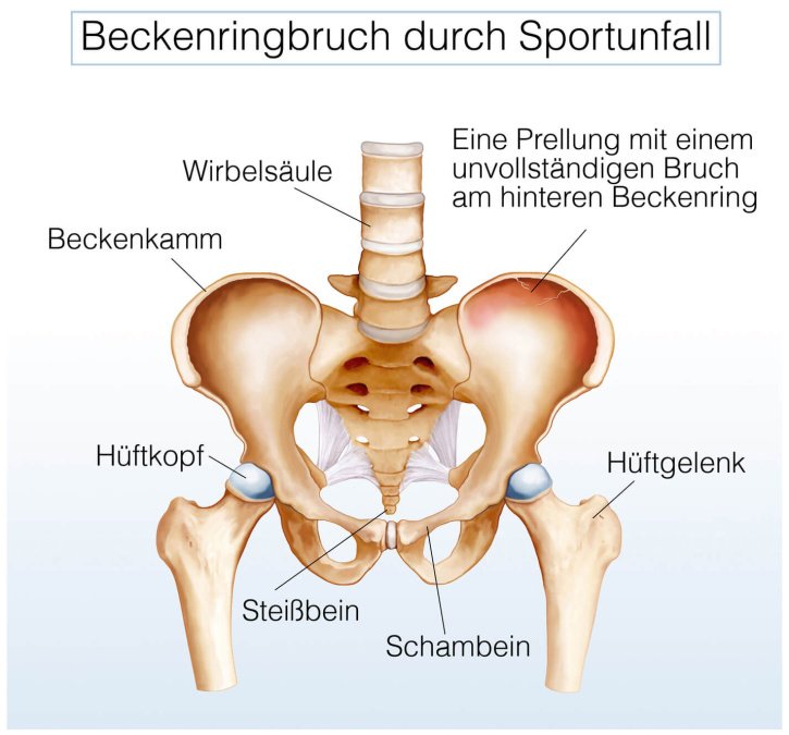 Anatomische Darstellung einer Prellung mit einem unvollständigen Bruch am hinteren Beckenring.