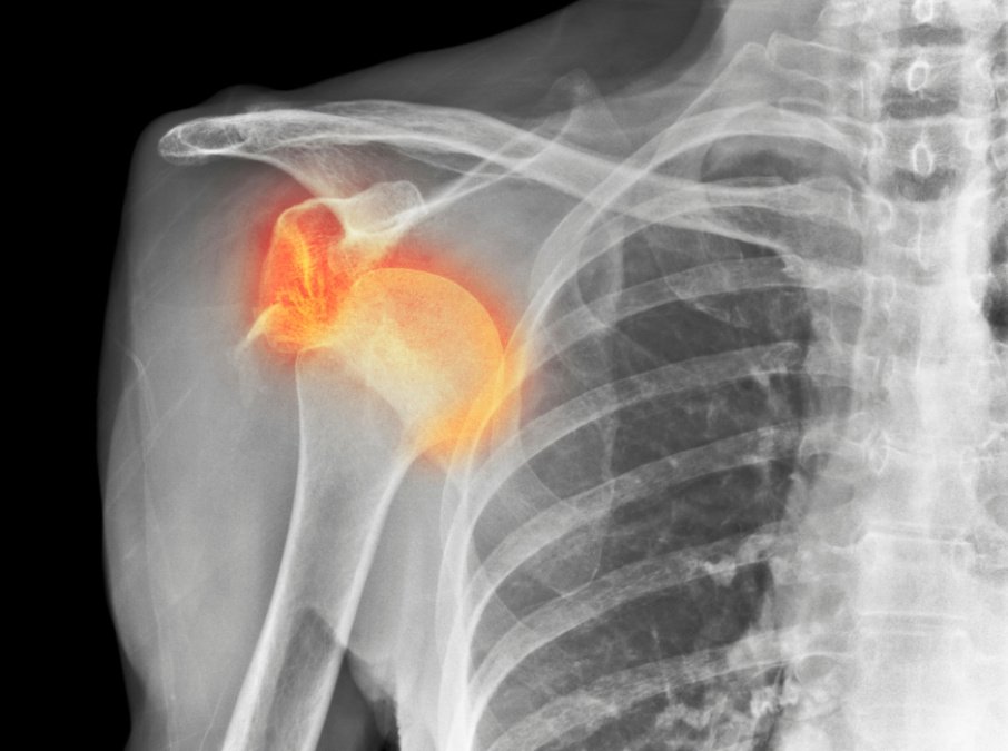 Anatomische Abbildung eines Oberkörpers: Roter Punkt im Schulterbereich symbolisiert Schulterbruch.