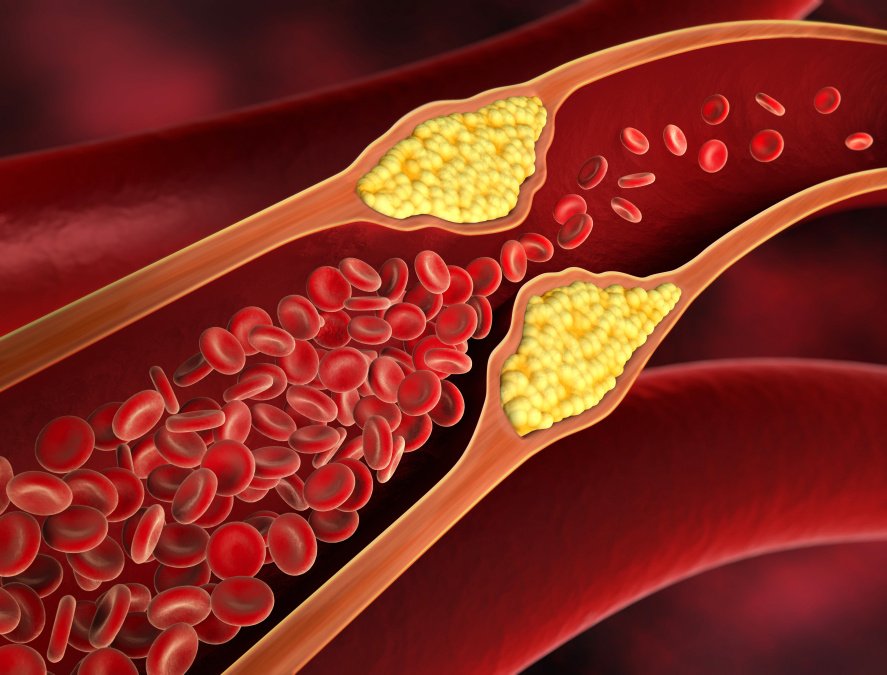 Darstellung eines inneren Blutgefäßes mit verengten Querschnitt und Plaquebildung durch Atherosklerose