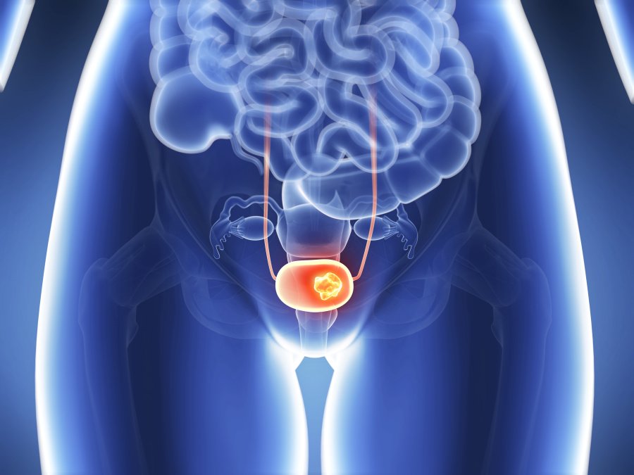 Schematische Darstellung des Intimbereiches einer Frau mit Fokus auf ein mit Krebs befallenes Blasensystem.