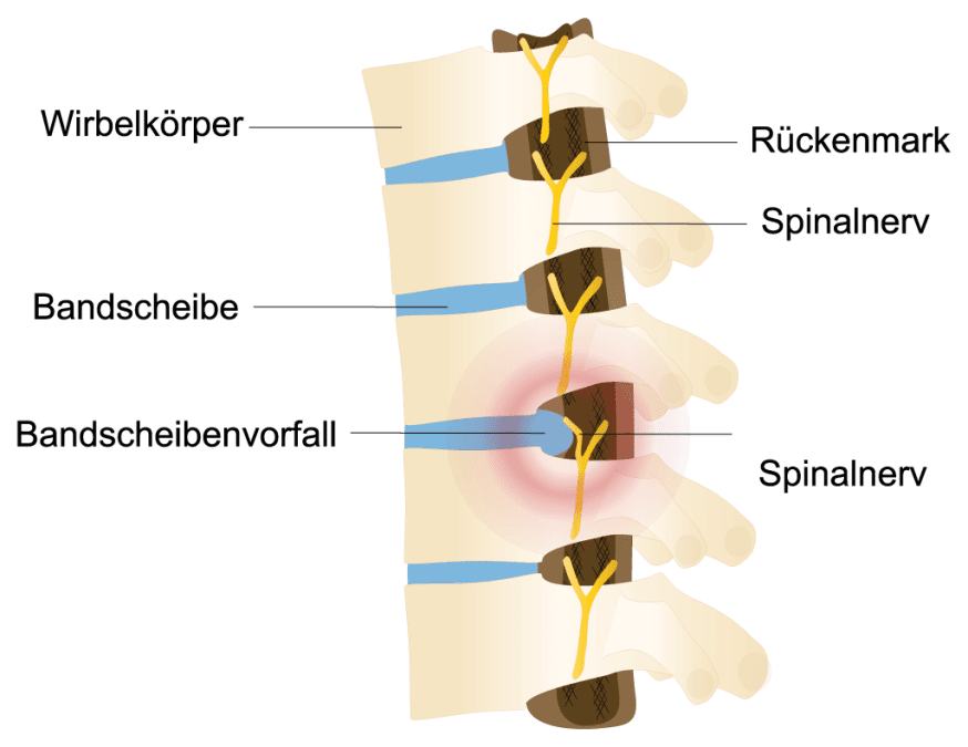 Schematische Darstellung eines Bandscheibenvorfalls, bei dem der Bandscheibenkern auf die Nerven drückt und Rückenschmerzen entstehen.