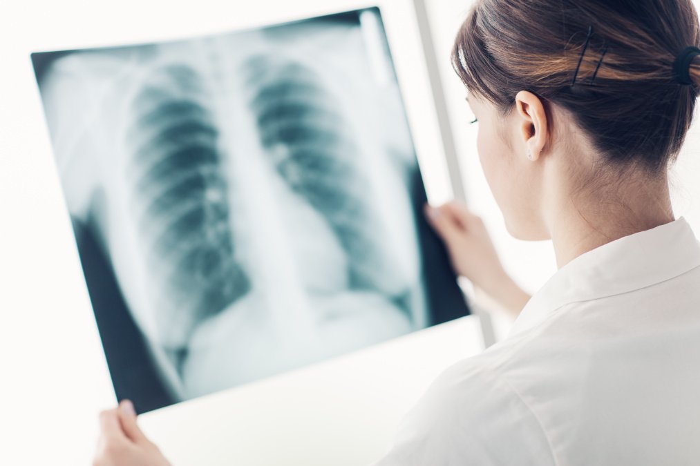 Frau hält Röntgenaufnahme des Oberkörpers einer Person mit Fokus auf die Lunge.